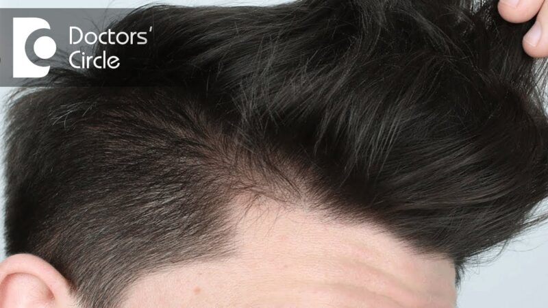 What causes hair loss in teenage boys with parents having good hair? – Dr. Rashmi Ravindra