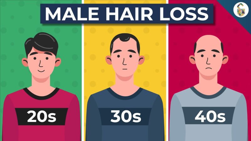 Going Bald? This Could Be Why…