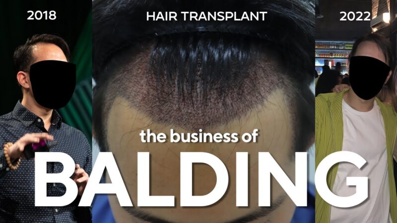 The Dreadful Business of Balding & Hair Loss