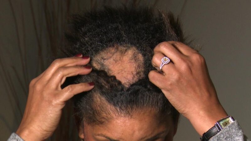 What Is Causing This Woman’s Extreme Hair Loss?