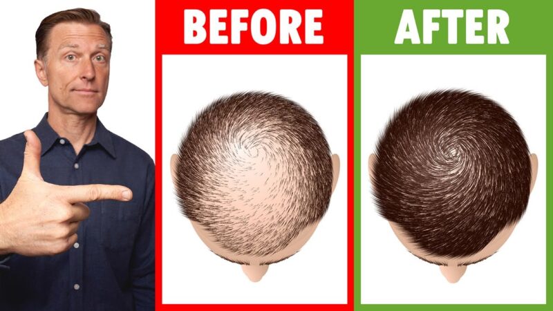 12 Home Remedies to Prevent Hair Loss and Regrow Your Hair