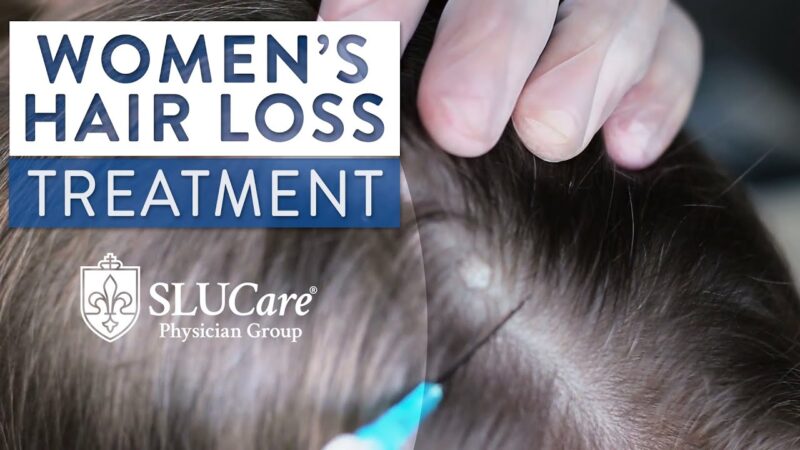 Treating Different Causes of Women’s Hair Loss & Alopecia – SLUCare Dermatology