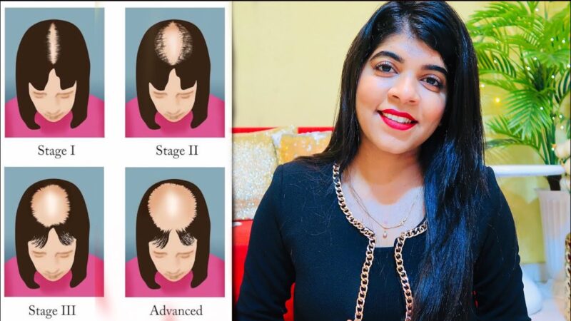 Extreme Hair Fall & Alopecia Solution | How to treat Alopecia at home