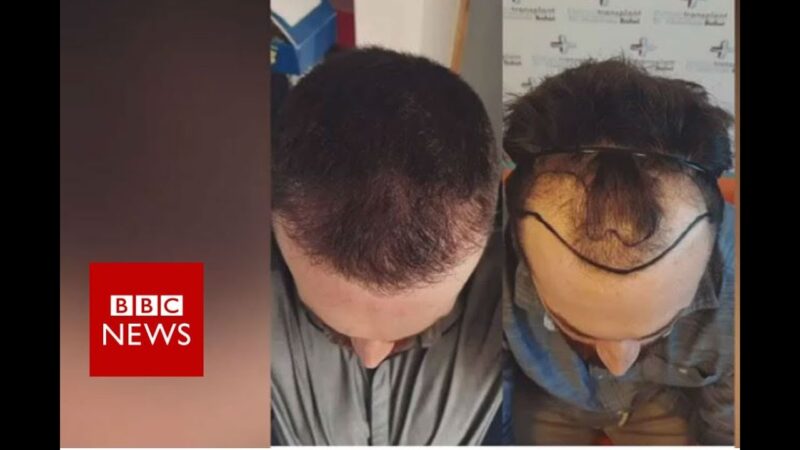 Hair loss: Fighting against my receding hairline  – BBC News