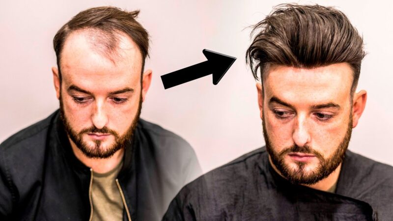 Mens Hair Loss Treatment | Hairstyle Transformation – Does it Work?