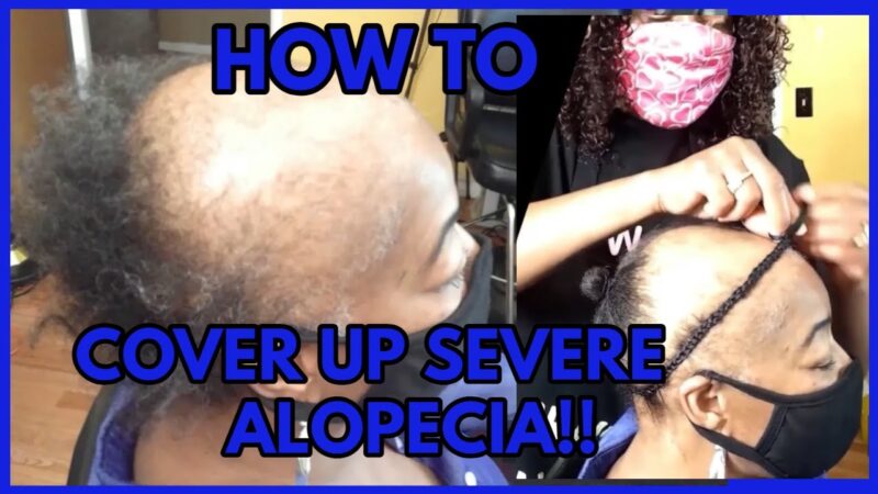 HOW TO COVER UP SEVERE ALOPECIA WITH A SEW-IN WEAVE