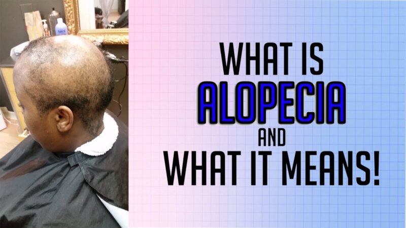 SUFFERING FROM HAIRLOSS| WHAT IS ALOPECIA AND WHAT IT MEANS!