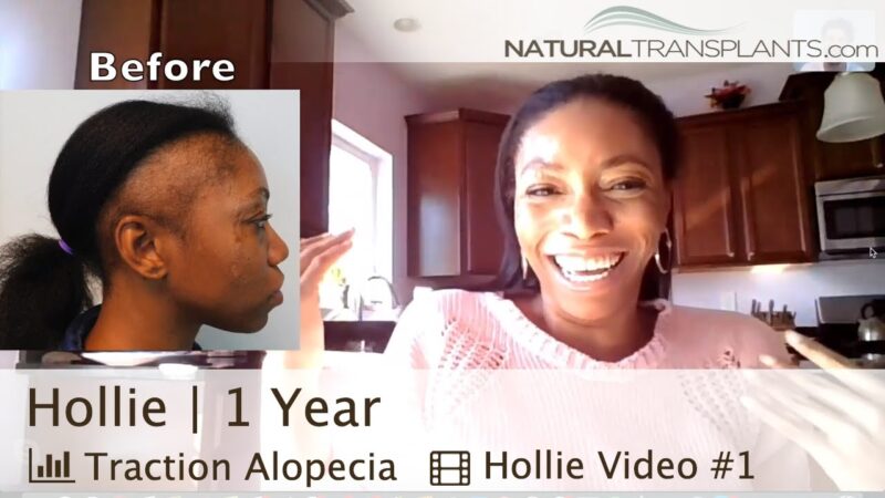 Hair Loss Treatment for Women Result | Traction Alopecia Hair Loss Treatment Result (Hollie)