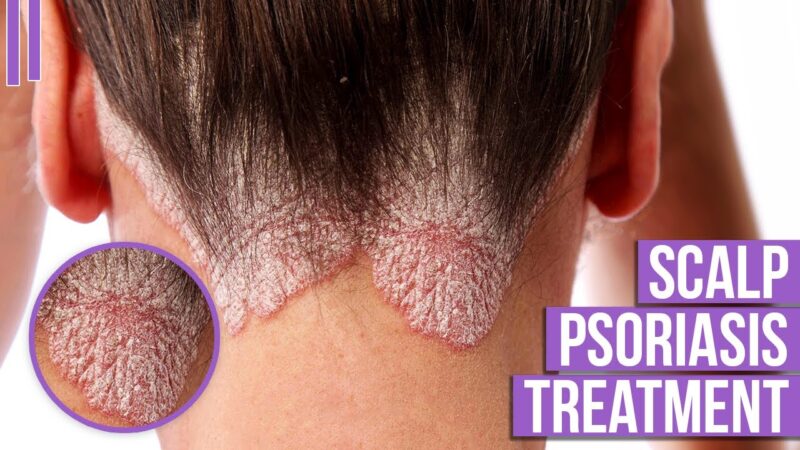 Scalp Psoriasis Treatment at Home