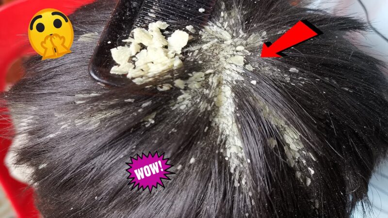 Dandruff Removal, Itchy Dry Scalp, Huge Flakes, Psoriasis Treatment and Scratching #388