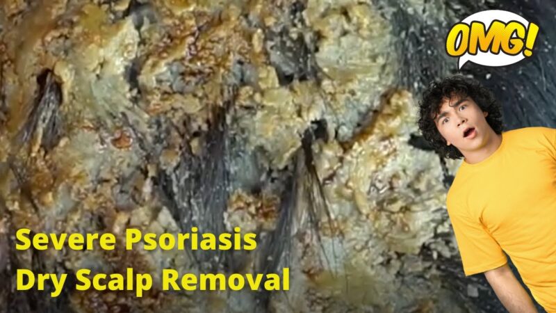 Removal of SEVERE Psoriasis Seborrheic Dermatitis Dry Scalp #amsr