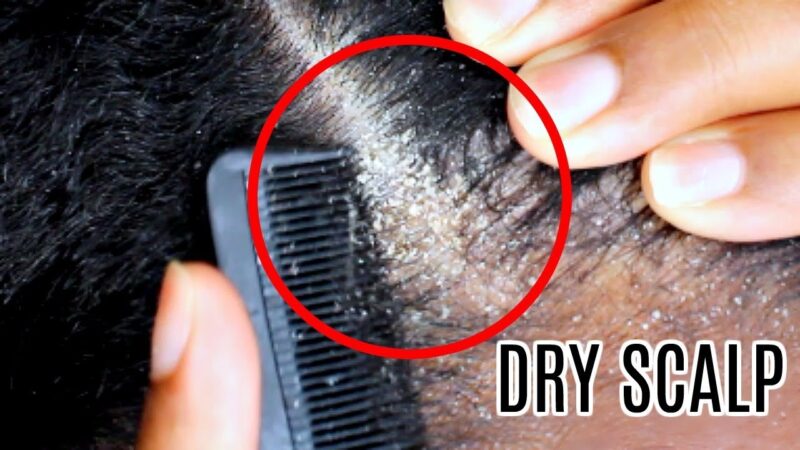 Dandruff Scratching ASMR no talking | Dry Scalp Psoriasis up close