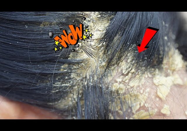 Dandruff Shampoo and Scratching, Itchy Dry Scalp, Huge Flake, Psoriasis Treatment #313