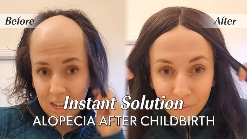 Instant Hair Loss Solution for Alopecia After Childbirth | Aida Hair Topper